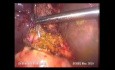 Choledochoduodenostomia laparoskopowa