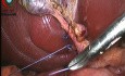 Kontrola przewodu pęcherzykowego za pomocą podwiązania szwów