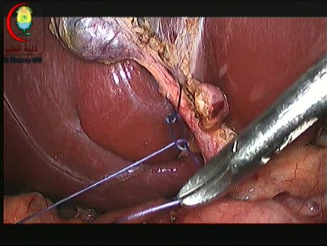 Kontrola przewodu pęcherzykowego za pomocą podwiązania szwów