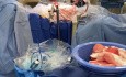 HIPEC dla organów klatki piersiowej
