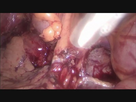 Laparoskopowa lewa hemikolektomia z powodu miejscowo zaawansowanego guza zstępnicy