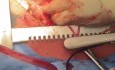 Pobranie płuca od dawcy z zatorowością płucną i wstecznym płukaniem roztworem Perfadex