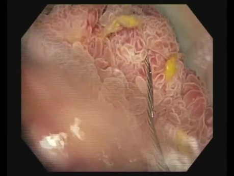 Polipektomia endoskopowa