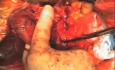 Pankreatoduodenektomia