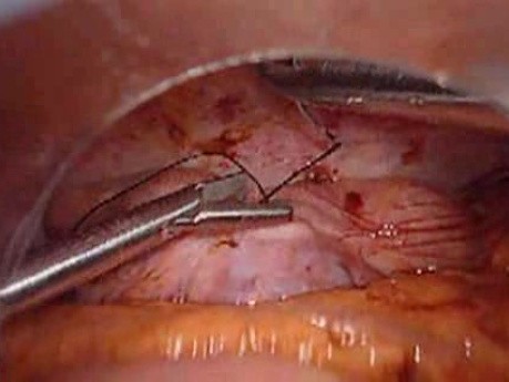 Perforacja okrężnicy z zapaleniem otrzewnej - laparoskopia (17 z 46)