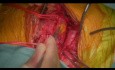 Śluzak lewego przedsionka serca powikłany zatorowością aorty zstępującej