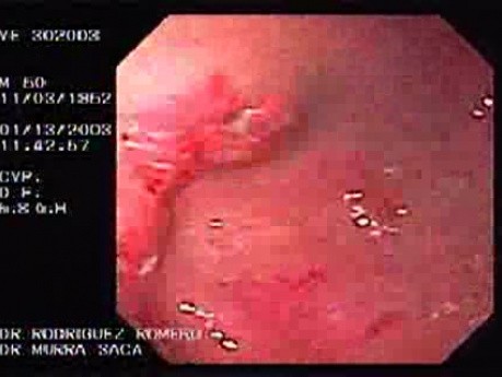 Cystogastrostomia (3 z 5)