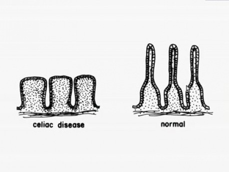 Celiakia - histopatologia - jelito cienkie