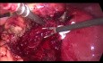 Cholecystektomia laparoskopowa z powodu ostrego zapalenia pęcherzyka żółciowego. Postępowanie z krwawieniem z loży pęcherzyka