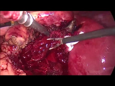 Cholecystektomia laparoskopowa z powodu ostrego zapalenia pęcherzyka żółciowego. Postępowanie z krwawieniem z loży pęcherzyka