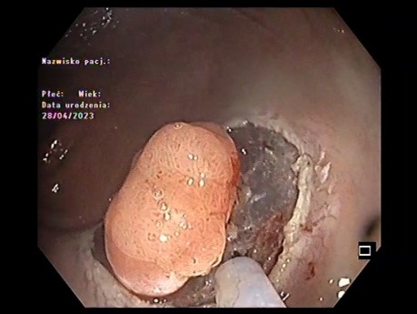 Endoskopowa dyssekcja podśluzówkowa małej zmiany w okolicy odbytniczej