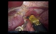 Robotyczna lewostronna hepatektomia i częściowa resekcja płata ogoniastego wątroby