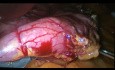 Jak wykonać laparoskopową rękawową resekcję żołądka