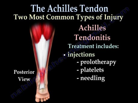 Zerwanie ścięgna Achillesa, jego zapalenie i naderwanie
