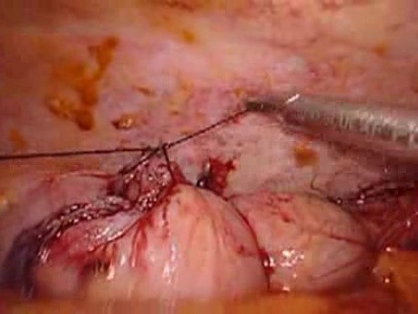 Perforacja okrężnicy z zapaleniem otrzewnej - laparoskopia (11 z 46)