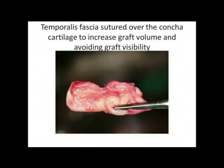 Nos siodełkowaty - technika korekcji przy użyciu chrząstki małżowiny usznej