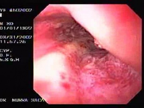 Krwotoczne Zapalenie Przełyku Spowodowane Alkoholizmem - Plamisty Rumień Błony Śluzowej 