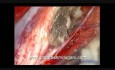 Mikrochirurgiczne usunięcie zlokalizowanej wewnątrzrdzeniowo torbieli skórzastej