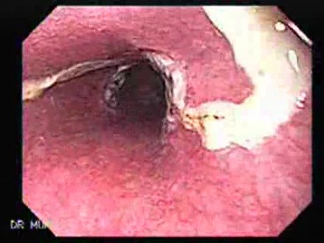 Żylaki żołądka - endoskopowa ablacja klejem cyjanoakrylowym (16 z 18)