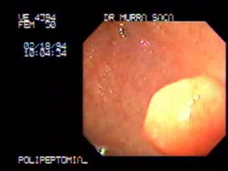 Polipektomia - pętla diatermiczna