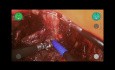 Radykalna prostatektomia laparoskopowa z użyciem robota chirurgicznego Versius