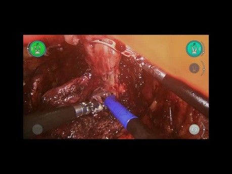 Radykalna prostatektomia laparoskopowa z użyciem robota chirurgicznego Versius