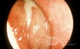 Sinusitis etmoide crónica