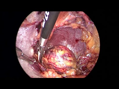 Adrenalektomia laparoskopowa zaotrzewnowa (Zespół Conna)