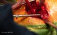 Prothèse totale de hanche par voie antérieure mini-invasive Dr Océane Brunet