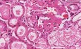Amyloidoza - nerka - histopatologia