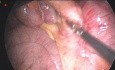 Post-appendectomy Resistent Pain and Pathology