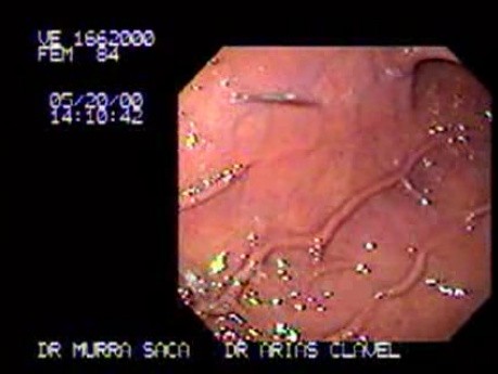 Przezskórna endoskopowa gastrostomia (1 z 3)