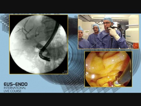 Ultrasonografia endoskopowa (EUS) z następczą endoskopową cholangiopankreatografią wsteczną (ECPW)