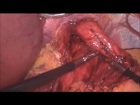 Laparoskopowa operacja plastyki rozworu przełykowego z fundoplikacją 360 stopni