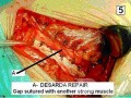 Przepuklina pachwinowa - operacja bez użycia siatki