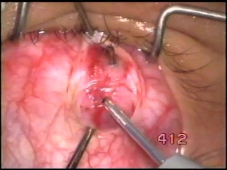 Myomektomia mięśnia dolnego skośnego oka wg Singha - ostrze Fugo