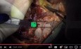 Kompletna technika pobrania płuc od dawcy - wersja 2