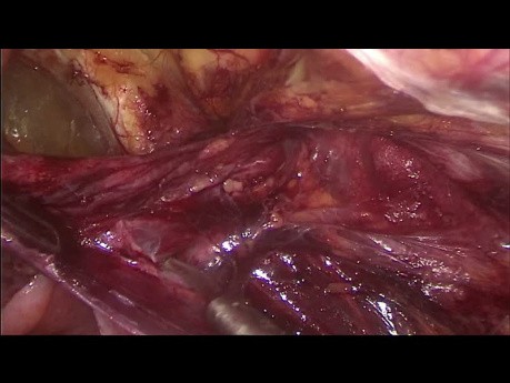 Leczenie laaroskopowe przepukliny pachwinowej i udowej