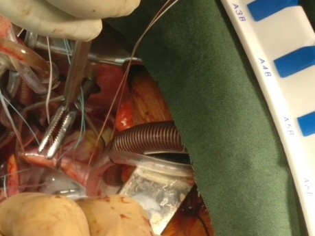 Naprawa zastawki mitralnej w małoinwazyjnej chirurgii serca (MICS) - technika bezpośredniej kaniulacji