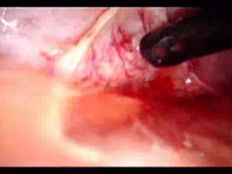 Perforacja okrężnicy z zapaleniem otrzewnej - laparoskopia (44 z 46)