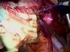 Sekwencyjna transplantacja serca i płuc