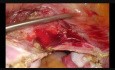 Całkowita laparoskopowa histerektomia u pacjentki po dwóch cięciach cesarskich