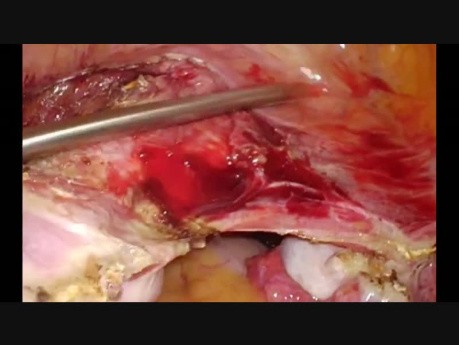 Całkowita laparoskopowa histerektomia u pacjentki po dwóch cięciach cesarskich