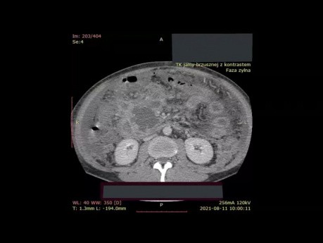 Wielorzędowa tomografia komputerowa jamy brzusznej z kontrastem u chorego z martwicą ograniczoną trzustki
