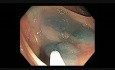Kolonoskopia: objaw nieunoszenia się brzegów ząbkowanego polipa wskazujący na obecność raka