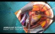Małoinwazyjna wymiana zastawki aortalnej