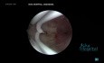 Histeroskopowa resekcja przegrody macicy