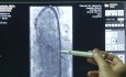 Wszczepienie zastawki aortalnej - przypadek pacjentki po zabiegu