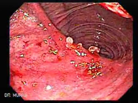Nawrotowy rak żołądka po resekcji żołądka typu Billroth II (4 z 6)