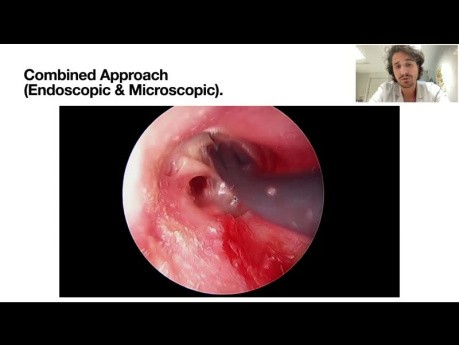 Webinar: Endoskopowe leczenie perlaków